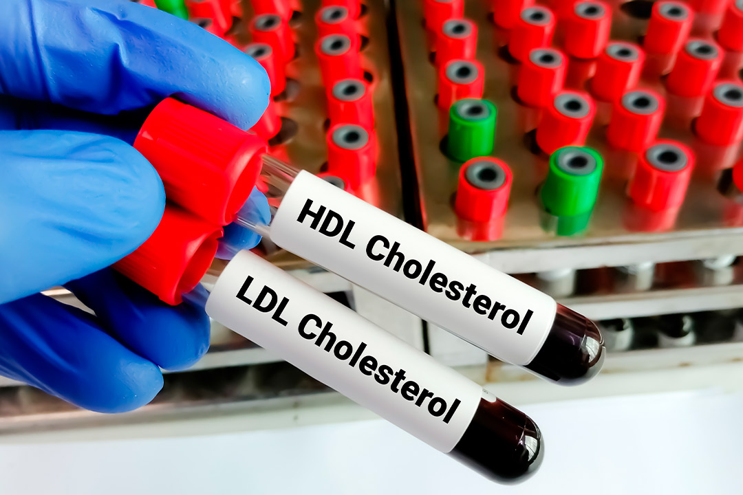 A person holds two blood tubes labeled 'HDL cholesterol,' emphasizing the importance of men's health.